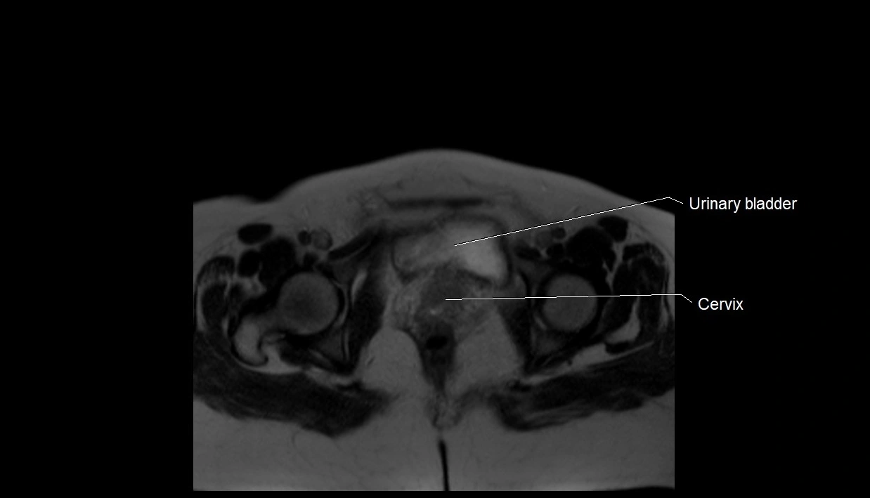 MRI fetal anatomy axial image 39.webp